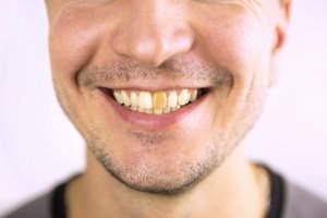 Yellow,Damaged,Tooth,Of,A,Smiling,Caucasian,Man,In,Close-up.