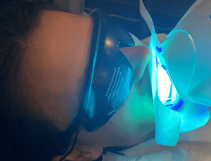 ZOOM Teeth Whitening process